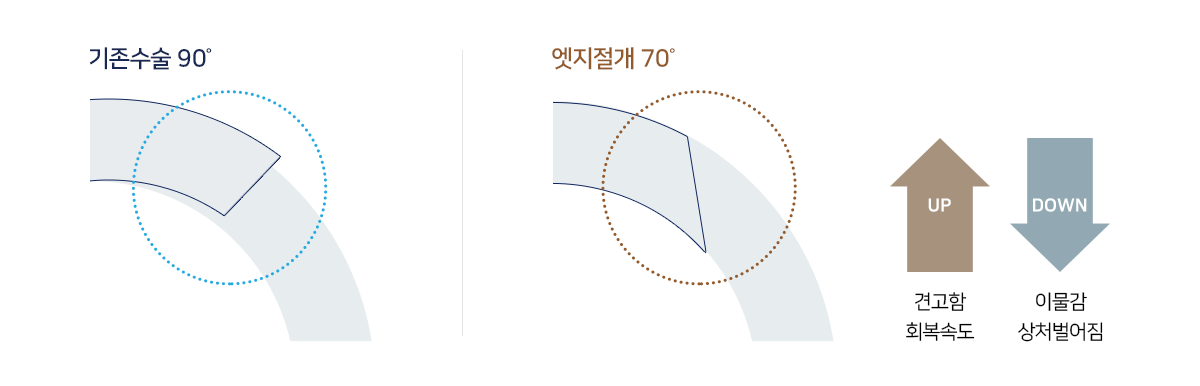 기존수술 90˚, 엣지절개 70˚, 견고함 회복속도 UP, 이물감 상처벌어짐 DOWN