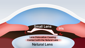 작은 렌즈를 삽입할 경우 